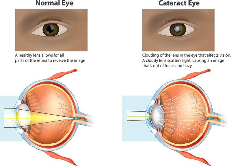 Cataract Diagram